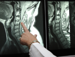 Radiculopathy Treatment | Spinal Disease Treatment | Torrance CA | Carson CA